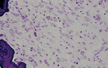 Imagen: Corte histológico de un ganglioglioma (Fotografía cortesía de la Fundación Ginebra para la Educación y la Investigación Médica).
